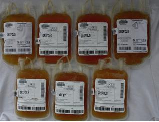 Obr. 2-3 Transfúzní vaky 2.2.1 Darování krve Darování krve je proces, kdy je dárci odebrána krev pro medicínské účely.