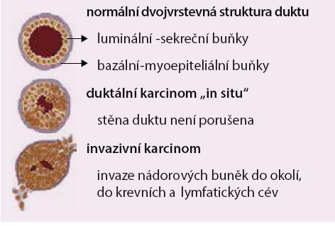 jeho výskyt stoupá s přibývajícím věkem. U žen se zvýšeným rizikem jeho incidence stoupá po celou dobu života, u ostatních žen dosáhne vrcholu v období menopauzy a pak zůstává na stejné úrovni.