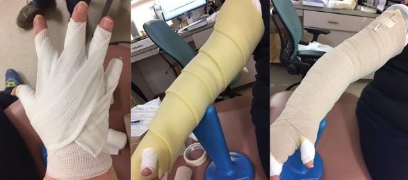 Obrázek 10 Technika bandážování horní končetiny Zdroj: Schaverien et al, 2018 Technika bandážování krátkotažným obinadlem na horní končetině. Krátkotažné obinadlo se aplikuje od prstů až k axile.