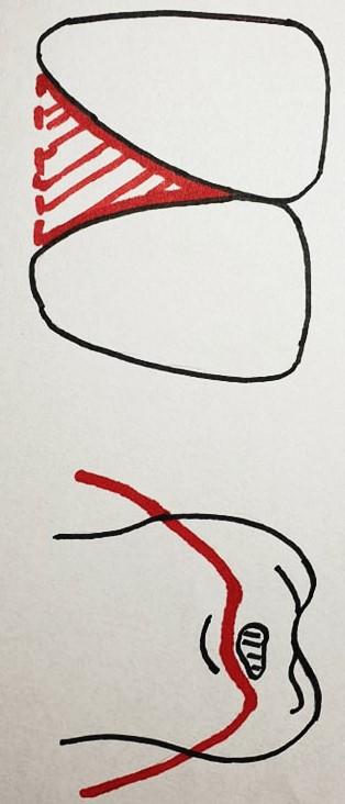 Tvarově lze papilu přirovnat k trojúhelníku složenému ze základny neboli basis papillae interdentalis a dvou přímek sbíhajících se v apex papillae interdentalis neboli hrot papily.