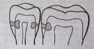 Kariézní léze lokalizovaná v dentinu, postupující do vnější ½ dentinu. Kariézní léze se nachází ve vnitřní ½ dentinu, hluboká léze.