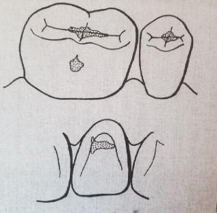 : Caries D-klasifikace development (A = from D1, B 11 = D2, to 22 C = years D3, D of = age: D4) A prospective radiographic study