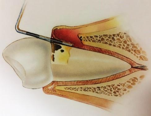 prokazatelný úbytek kosti alveolárního výběžku (viz obr. 32).
