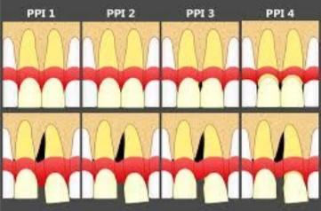 Obr. 41 - Znázornění klasifikace dle doktora Cardaropoliho PPI Převzato z: JAMWAL, D.: Treatment of Interdental papilla: a review. Galore International Journal of Health Sciences and Research.