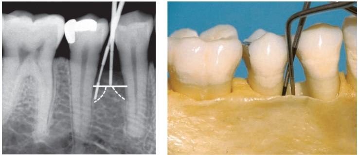 Obr. 45 - Měření hloubky parodontálních kapes na aproximální straně Převzato z: WOLF, H. F.; RATEITSCHAK, K. H.: Color Atlas of Dental Medicine Periodontology. 3rd edition. Stuttgart: Thieme. 2004.