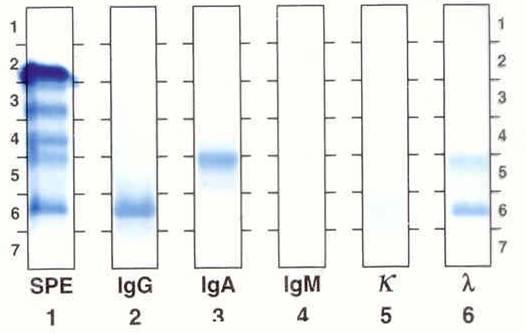 IMUNOFIXACE VZORKU SÉRA NEMOCNÉHO S PARAPROTEINY IgG a IgA + - LEGENDA: sloupec č. 1: monoklonální pruhy na pozici 4 a 6 sloupec č.