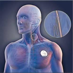 mozková stimulace stereotaktická chirurgie (prakticky se nepoužívá) fytoterapie (extrakty z léčivých