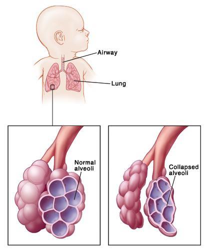 1.3 Syndrom dechové tísně Syndrom respirační tísně je nejčastějším plicním onemocněním u novorozenců, kteří se narodí o šest a více týdnů dříve a u dětí s nízkou porodní hmotností, a to až u 90 %