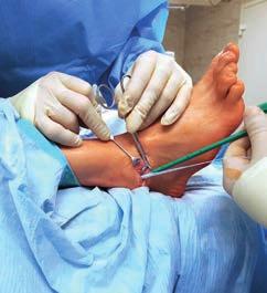 arthroplasties in human body: metal load Použití dlahy Aptus TMT-1 při Lapidusově operaci pro hallux valgus s nestabilitou I.