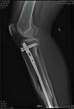stability. Nyní indikujeme k hřebové osteosyntéze i některé zlomeniny proximálního a více distálního konce holenní kosti. Osteoinduktivní vlastnosti jsou další výhodou nového titanového hřebu.