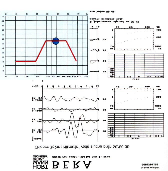 LISTY KLINICKÉ LOGOPEDIE 2/2020 35 Obrázek 7.: anebo konečně jako pokles pouze v oblasti 2 khz Vyšetření BERA je nepřesné ve vysokých intenzitách stimulace.