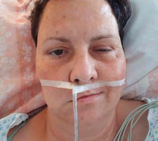 tonus a symetrie dobrý až přiměřený pohyb kompletní zavření s minimální snahou lehká asymetrie zřejmá, ale ne znetvořující symetrie tváří, synkinéza je nápadná, ale ne těžká, může mít hemifaciální