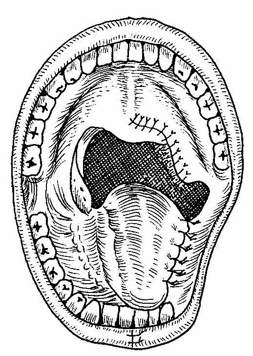 uvulárním lalokem sutura