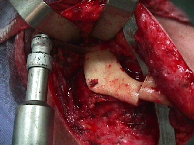 orofaryngeální tumor s