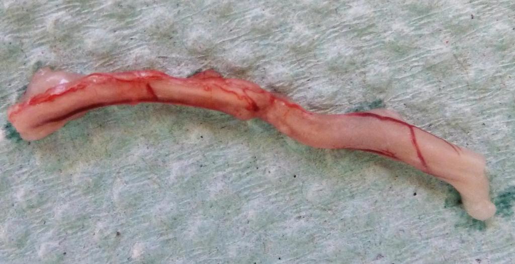 Ve vzdálenosti 5 mm od hlavy nadvarlete byla resekována 20 mm dlouhá část chámovodu, v jejímž centru bylo místo primárního operačního výkonu a reparační změny.