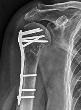 A B Obr. 10: Příklady použití implantátů na RTG snímcích. A) Dlahová osteosyntéza proximálního humeru. Křivohlávek et al. (2014), obr. 3a.