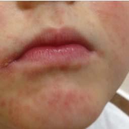 Zkušenosti dětského dermatologa s kyselinou fusidovou kazuistiky Kazuistika č.