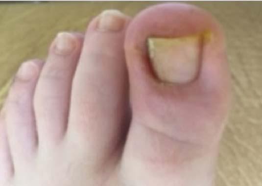Zkušenosti dětského dermatologa s kyselinou fusidovou kazuistiky Kazuistika č.