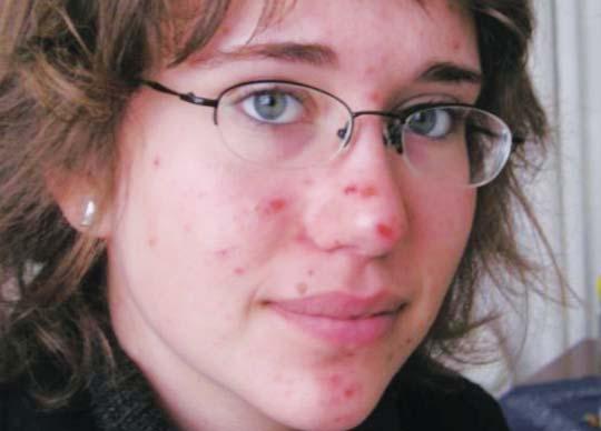 Diagnóza: acne papulosa st. II. cum excoriatonem multipl. eczema atopicum in anamn.