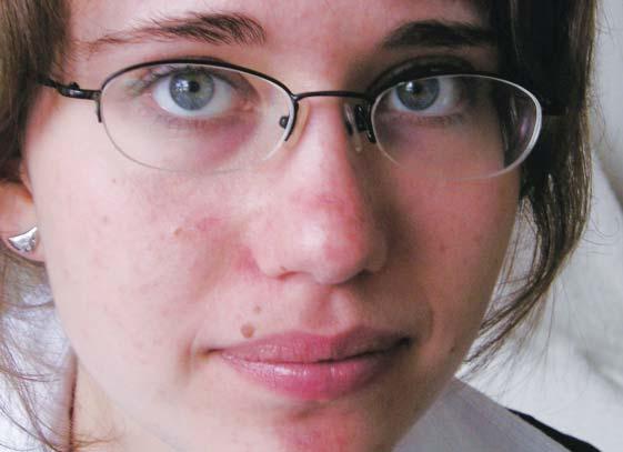 traumatizace projevů. Byla zahájena léčba lokálním adapalenem v krému 3 hodiny denně s postupným navyšováním o 1 hodinu denně a sledováním tolerance (na celý obličej).