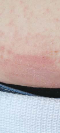 Zkušenosti dermatologa s kyselinou fusidovou kazuistiky Objektivně byly v oblasti obočí, tváří a brady přítomny splývající červenorůžové plošky, infiltrované, místy s drobnými žlutavými stroupky.