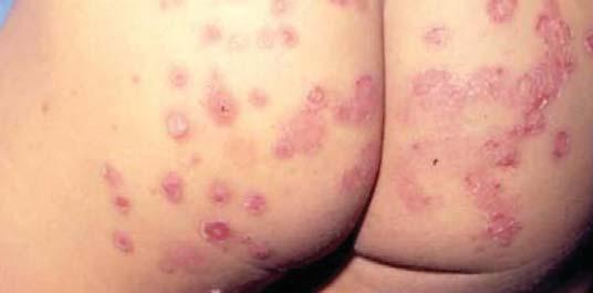 Bakteriální infekce kůže v ambulanci pediatra Obrázek 1. Impetigo bullosa Obrázek 2. Impetigo bullosa1 Obrázek 3. Impetigo bullosa 2 Obrázek 4.