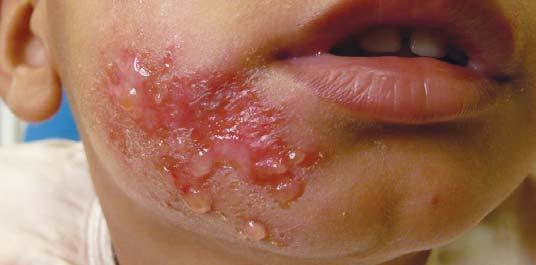Tento toxin způsobuje intraepidermální štěpení a tvorbu puchýřů pod nebo v úrovni stratum granulosum. Nejčastěji vzniká na tváři, může být jen na malé oblasti, ale bývá i diseminované.