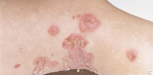 Nebulózní impetigo začíná jako malá vezikula nebo pustula, která praská do červené vlhké spodiny. Když se ložisko šíří do okolí, nahromadí se v něm medově žluté až bílohnědé pevně adherující krusty.