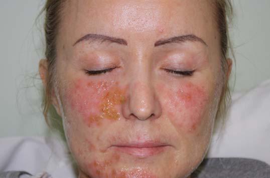 Bakteriální infekce kůže v ambulanci pediatra Obrázek 6. Hot tub folliculitis Obrázek 7. Furunkul např. v termálních koupalištích nebo po wellness pobytech.
