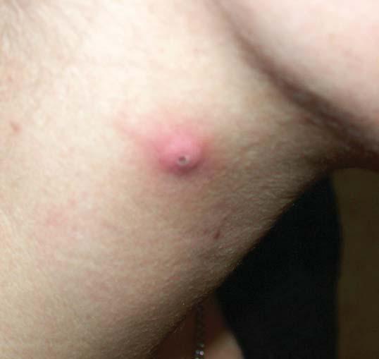 Důležitá je spolupráce pacienta, u dětí i jejich rodičů, při léčbě. Proto léčbu volíme tak, aby byla pro rodiče i pacienta přijatelná.