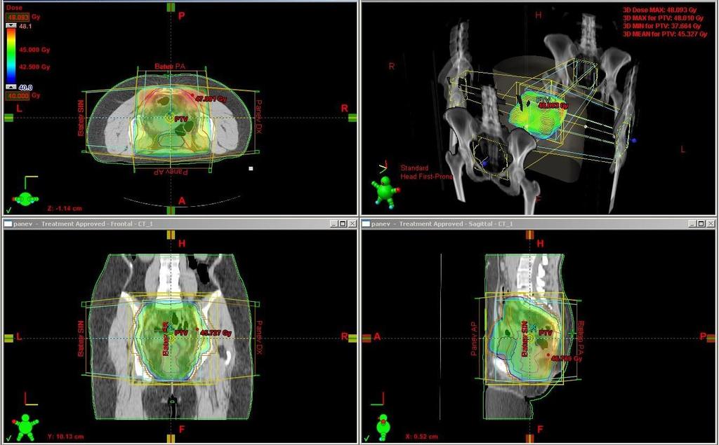 3.2. Léčba Předoperační radiochemoterapie sestávala z radioterapie na oblast malé pánve ze 4 polí box technikou, lineárním urychlovačem (Clinac 600, Clinac 2100, nebo Varian, Varian Medical Systems,