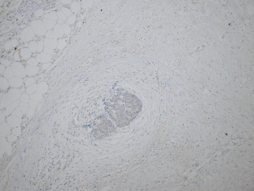 3.3. Metodika imunohistochemického vyšetření VEGF V archivních parafinových bločcích byla imunohistochemicky vyšetřena exprese VEGF. Ve světelném mikroskopu byla hodnocena pozitivita reakce.