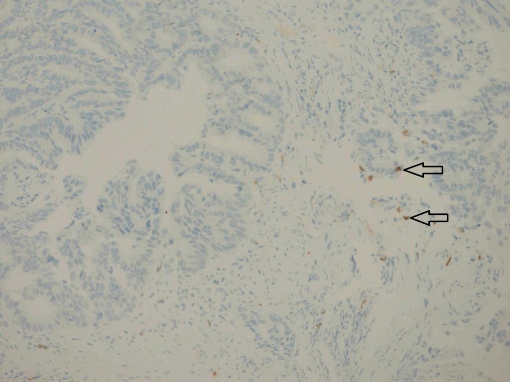 3.4. Metodika imunohistochemického vyšetření CD8+ tumor infiltrujících lymfocytů K imunohistochemickému průkazu CD8+ tumor infiltrujících lymfocytů v archivních parafinových bločcích byl používán