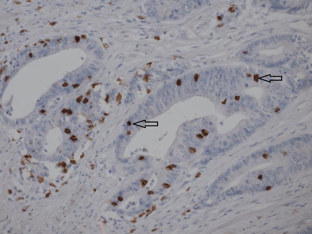 Obrázek 12 Vysoká hustota CD8+ tumor infiltrujících lymfocytů ve středně diferencovaném adenokarcinomu rekta v