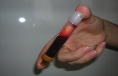 Hemolýza - příčiny příliš těsný turniket delší dobu použití příliš úzké jehly vystřikování krve ze stříkačky