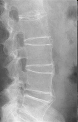 ANKYLOSUJÍCÍ SPONDYLITIS = BECHTĚREVOVA CHOROBA Chronické zánětlivé onemocnění postihující páteř (může postihovat i kořenové klouby)