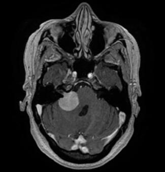 U některých pacientů s prokázanou dysfagií po operaci vestibulárního schwannomu byla nutnost založení tracheostomie a zavedení gastrické sondy (Ward, Francis et al., 2012).