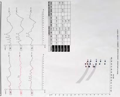 V praxi klinického logopeda se na našem pracovišti u pacientů po operaci vestibulárního schwannomu nejčastěji setkáváme s jednostrannou lézí n.vii, n.x a n.xii.