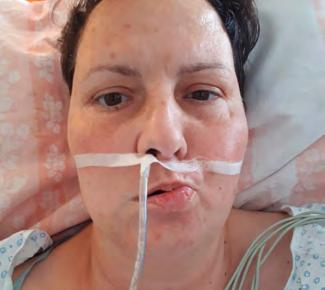 pohyb nekompletní zavření očí asymetrie s maximální snahou jen lehký, sotva nápadný pohyb asymetrický faciální vzhled žádný pohyb nekompletní zavření očí lehký pohyb normální funkce lehké mírné
