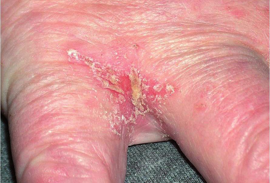 MODERNÍ FARMAKOTERAPIE V DERMATOLOGII Rizikové tedy jsou: tělesný kontakt s postiženým, resp.