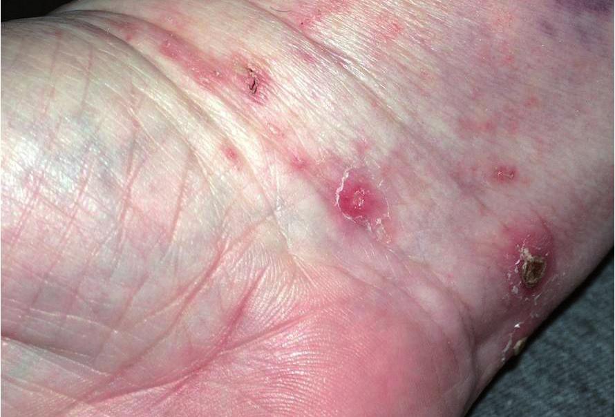 Parazitární dermatózy Obr. 2.