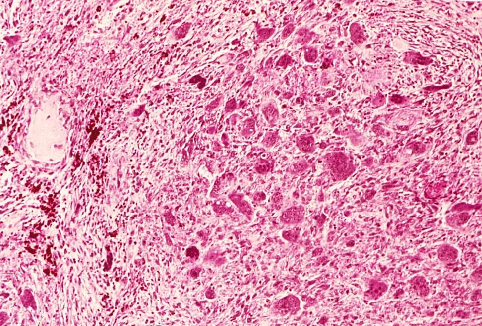 tumor