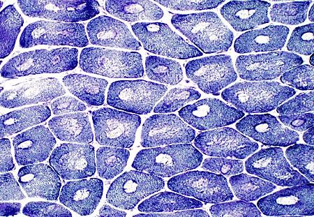 myopathy