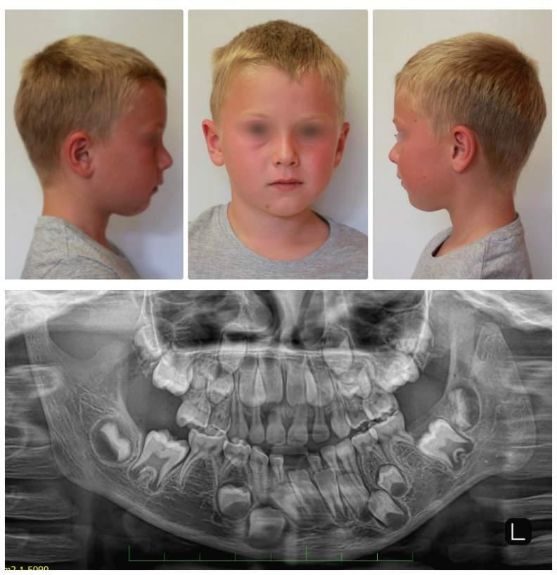 Obr. 10 Asymetrie obličeje u CC (condylar-coronoid) deformace. Extraorální fotografie a ortopantomogram 7 letého pacienta (Obrazová dokumentace Stomatologické kliniky FNKV a 3. LF UK, Praha).