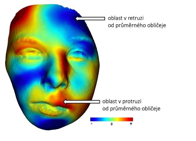 Obr. 27 Barevná mapa obličeje pacienta s OAVS ukazující srovnání s průměrným obličejem příslušného věku a pohlaví. Červené oblasti jsou v protruzi, modré oblasti v retruzi od průměrného obličeje.