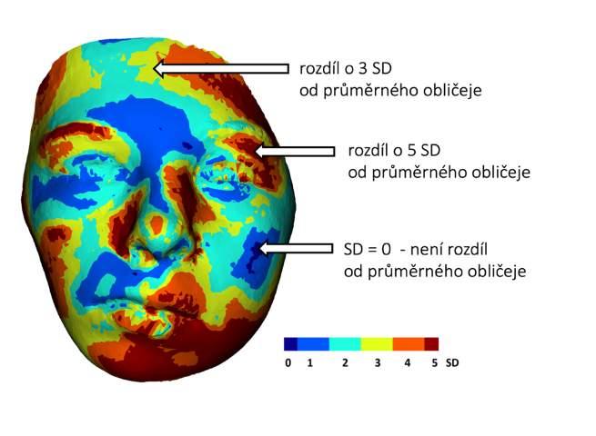 Obr. 28 Barevná mapa obličeje ukazující odchylky pacienta s OAVS od obličejů příslušného věku a pohlaví pomocí SD skóre.