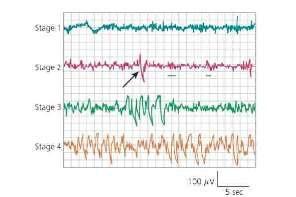 a byli pořád vzhůru. Při přechodu z bdění do N1 stádia spánku se změní na EEG rychlejší aktivita alfa (8-13 Hz) na pomalejší theta aktivitu s výskytem typických vertexových vln.