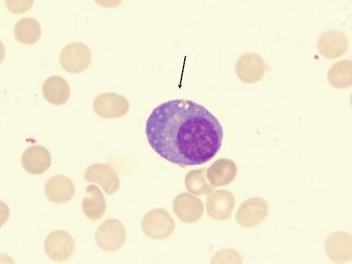 Eosinofily,