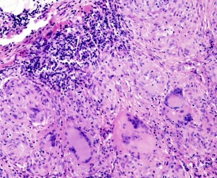 Sarkoidóza chronické granulomatózní zánětlivé onemocnění neznámé etiologie postihuje zejména mediastinální LU, plíce, kůži, oko; granulomy sarkoidózy se mohou objevit kdekoli nenekrotizující