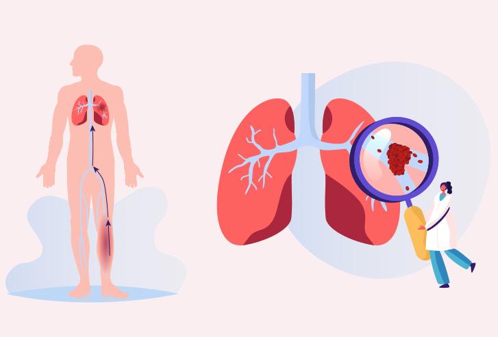 Plicní embolie Plicní embolie je velmi nebezpečný stav, jehož příčinou je až v 90 % případů hluboká žilní trombóza dolních končetin.